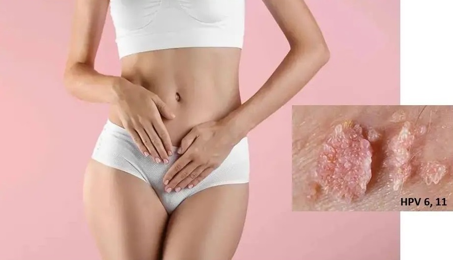 Κονδυλώματα - Η ύπουλη ασθένεια αντρών και γυναικών